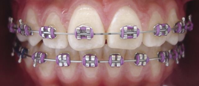 Me pongo los Braquets