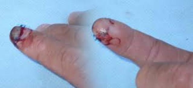 My Broken Finger(worse than the picture got it off google)
