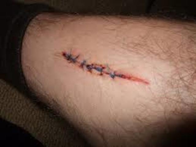 When I Cut My Leg Open