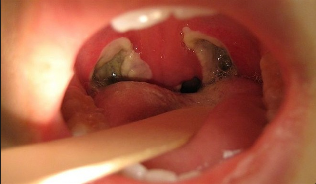 When I got my tonsils cut out.