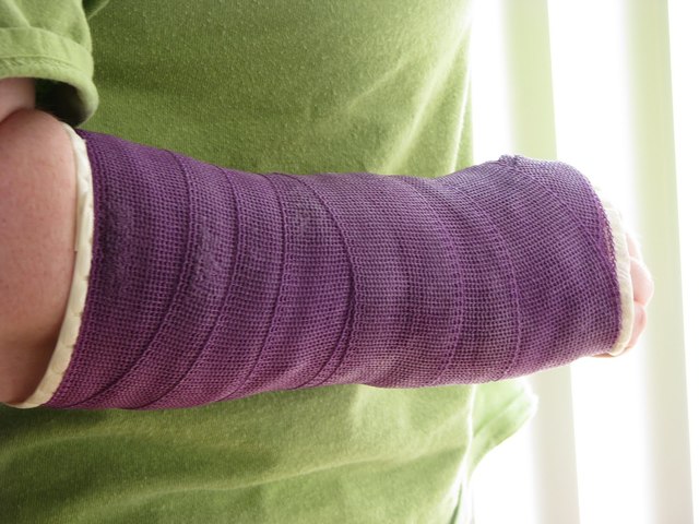 Broken Arm