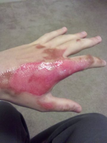 Burnt her self in a kitchen accident