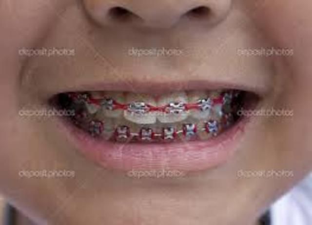 Braces