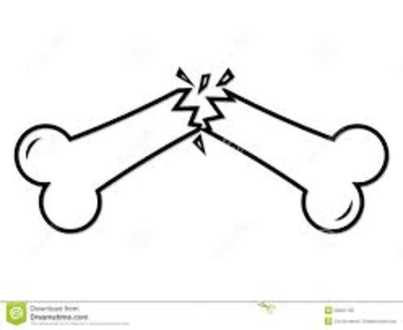 Broke my collar bone, 7 years of age