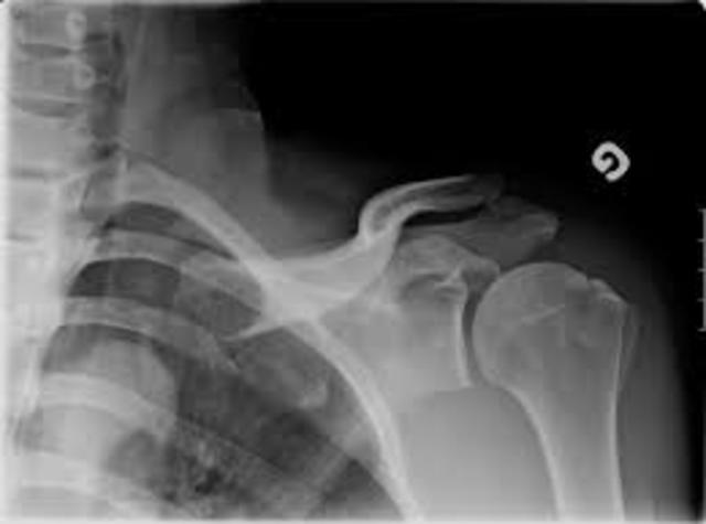 The time i broke my sholder bone