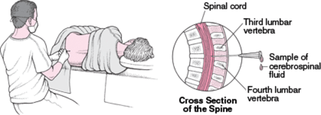 Doctors Thought I Had Spinal Meningities.