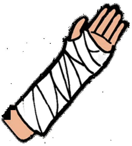 The 5 Weeks Without A Left Arm