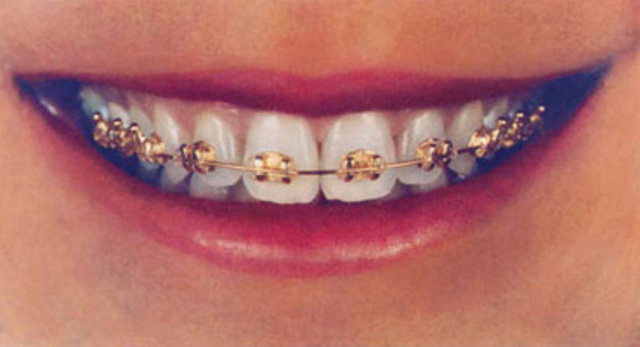 My braces