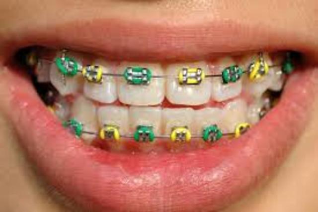 Got Braces On Again