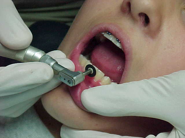 Got Braces Off Again