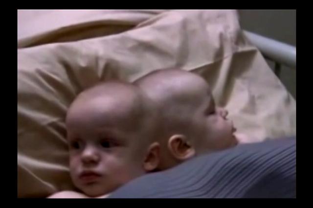 1987-5 SEPTIEMBRE OPERACION DE LOS BEBES