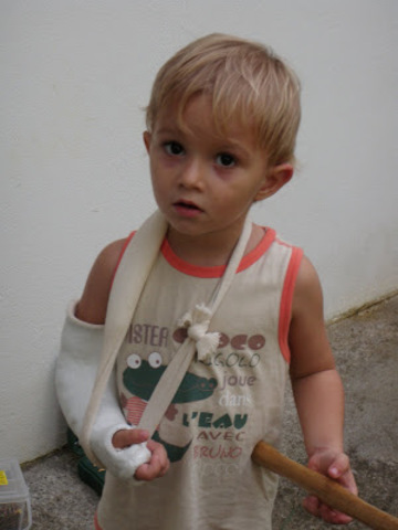 Yo me rompio el brazo