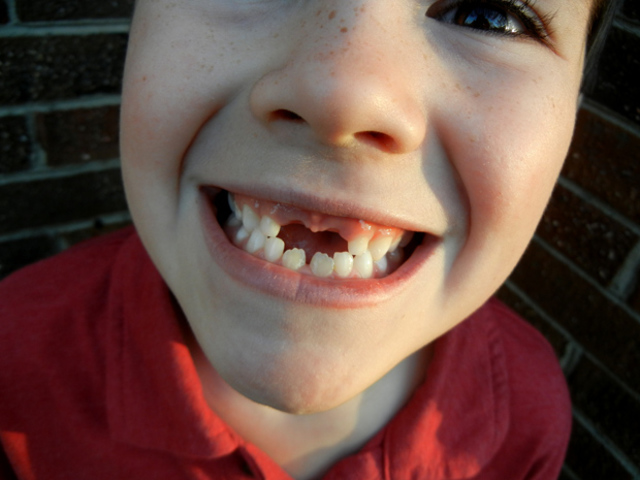 Cuando Perdi mis dientes delanteros