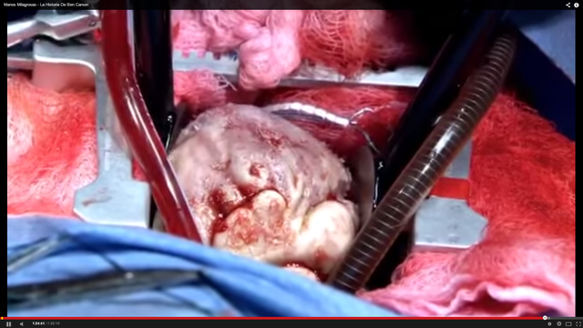 sale con exito la separacion de los siameses