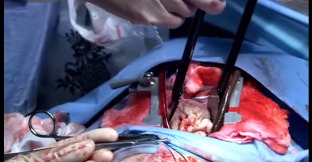 BEN CARSON PRACTICA SU PRIMERA SEPARACION CRANEAL DE GEMELOS SIAMESES