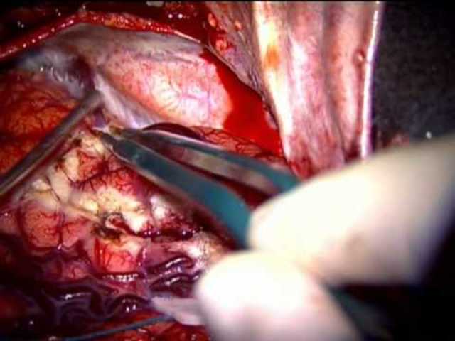 ben carson su caso de epilepcia