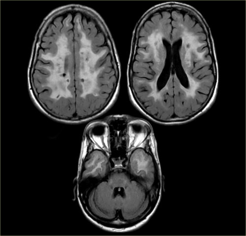 Virchow published his famous aphorism "Omnis cellula e cellula" meaning every cell stem forms from another cell.He stated that all diseases involve change in normal cell which led to medicine practice.