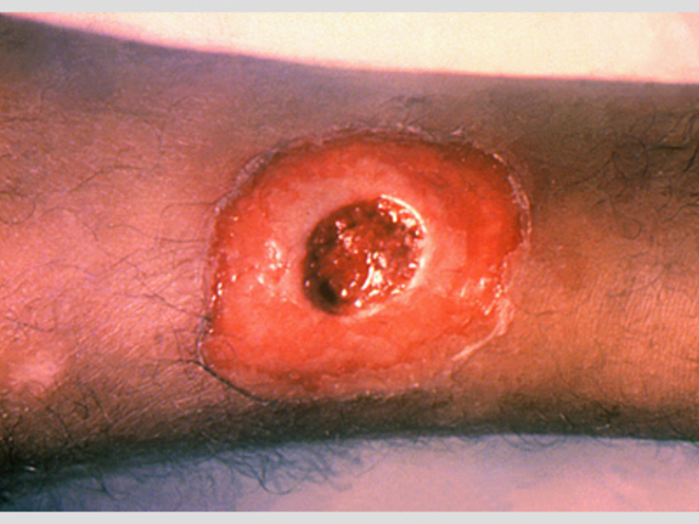 Cutaneous Diphtheria