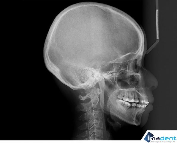 Se le desarrolló un tumor cancerígeno en la boca, y le tuvieron que quitar una gran parte de la mandíbula y poner una prótesis.