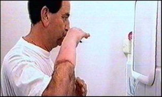 First  Successful Hand Transplant