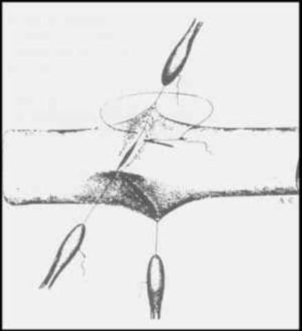 1902 - 1908 Carrek Develops Technique for connecting blood Vessels