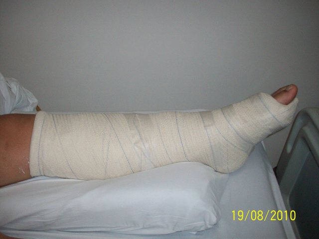 "Perna" quebrada - Ana Paula