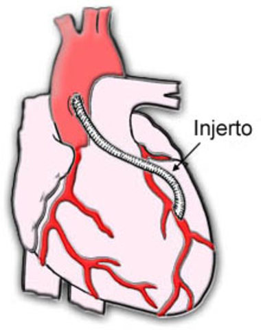 Soporte fijo para marcapasos