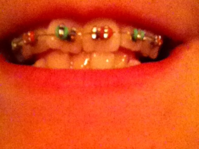 BRACES!