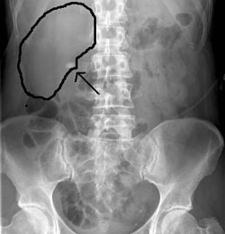 My First Kidney Stone