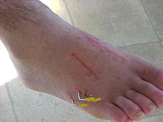 The most pain i've ever been in