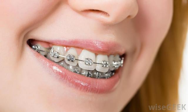 Braces
