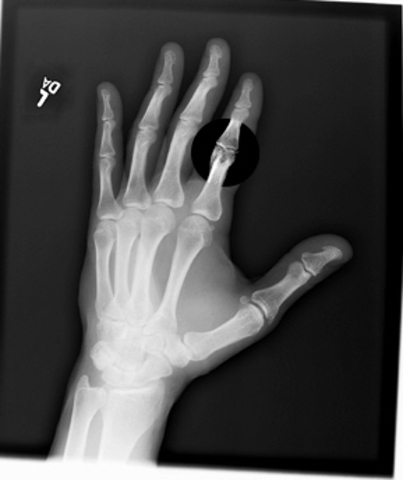 Broke My Index Finger