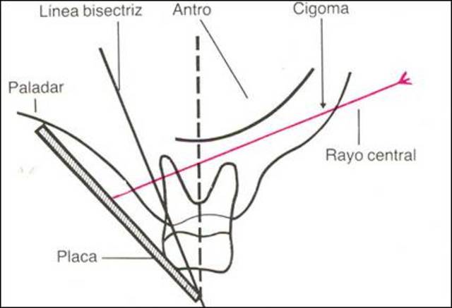 TÉCNICA DE BISECTRIZ DEL ÁNGULO O CONO CORTO