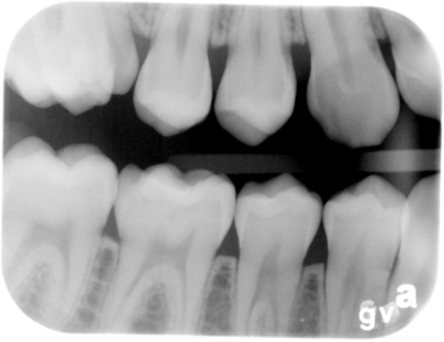 TÉCNICA DE ALETA MORDIBLE