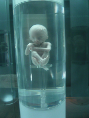 FETO DE 17 A 20 SEMANAS