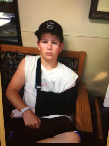 Day I broke my arm