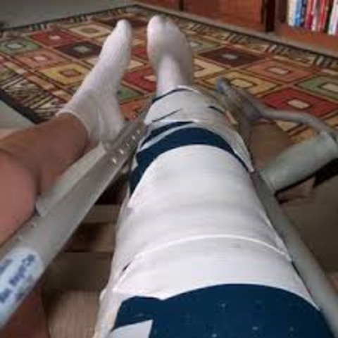 When I broke my knee cap.