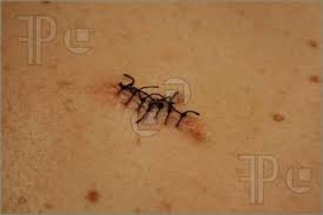 Tuve puntos de sutura.