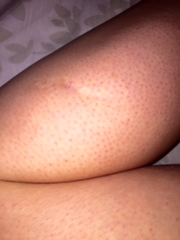 I got surgery on my leg