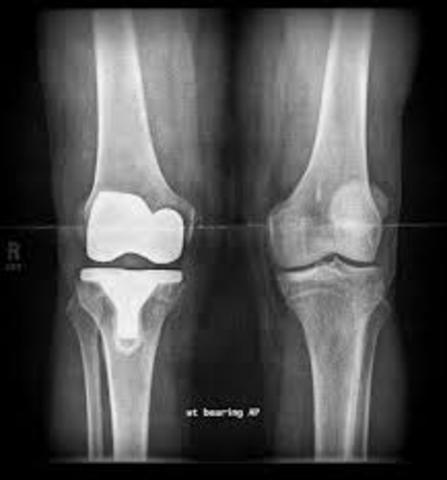 1st Grade Broken Leg