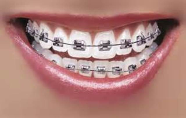 Braces