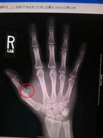 Broke my thumb