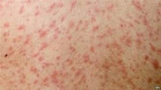 Rhazes discovered difference between small pox and measels