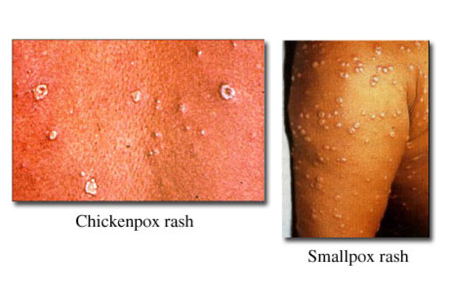 Rhazes discovered difference between smallpx and measles