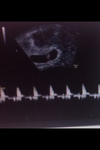 3 SEMANA DE EMBARAZO