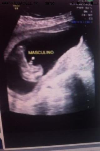 5 SEMANAS DE EMBARAZO