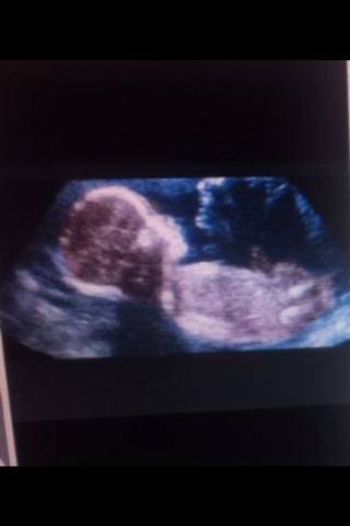 7 SEMANA DE EMBARAZO