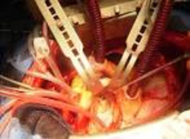 Successful Open Heart Surgery