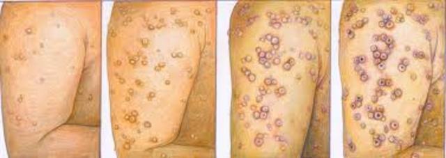 WHO declares smallpox eradicated