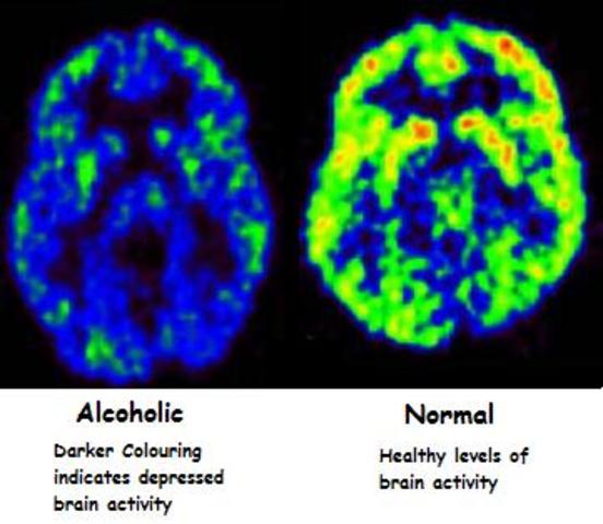 Emotional Processing And Brain Activity In Youth At High Risk For Alcoholism